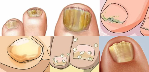 Toenail fungus